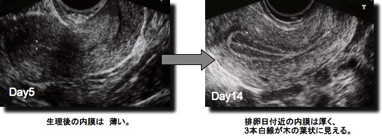 子宮 内 膜 厚 さ エコー