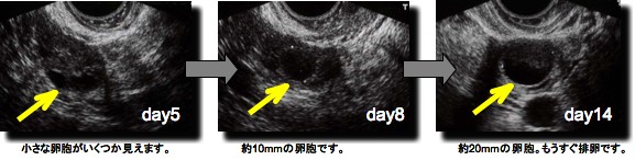 卵 管 炎 エコー で わかる