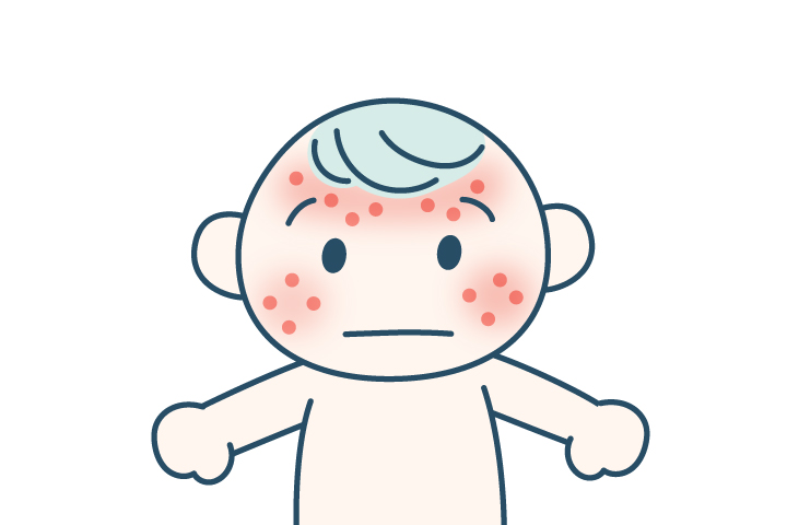 赤ちゃん湿疹